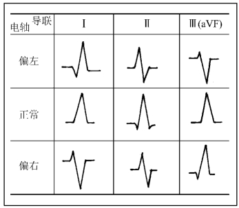 心电轴怎么画图片